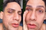 Arquiteto é agredido por grupo de jovens após se vestir como drag queen no Carnaval: ‘Levei um soco’