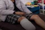 Jovem amputa o próprio pé para tentar vaga por cota na faculdade de medicina; saiba mais
