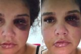 Cantor é acusado de agressão e cárcere privado por esposa que desabafa ao surgir com rosto deformado; veja vídeo