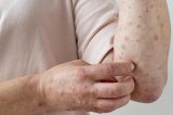 Brasil atinge 90 casos de mpox em 2026 após novas confirmações nesta terça-feira
