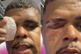 Influenciador baiano é agredido com soco no rosto durante Carnaval em Salvador: “Cheio de ódio”
