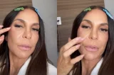 Ivete Sangalo revela sequela após cirurgia e revela que colocou presilhas de titânio no rosto