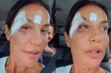 Cirurgia de Ivete Sangalo durou quase 6h e corrigiu fratura na mandíbula; entenda Cirurgia de Ivete Sangalo durou quase 6h e corrigiu fratura na mandíbula; entenda