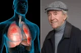 Veja os sinais de alerta e como identificar a pneumonia, doença que matou Juca de Oliveira