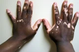 Ambulatório amplia acesso à dermatologia para peles pretas e pardas