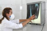 Pernambuco mantém alta de casos de tuberculose em 2025, com mais de 6 mil notificações