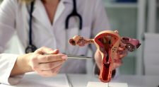 Câncer de endométrio: sangramento uterino anormal é sinal de alerta